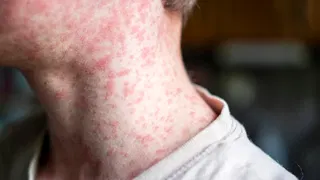 18-year-old dies of measles in PA from severe neurological complication