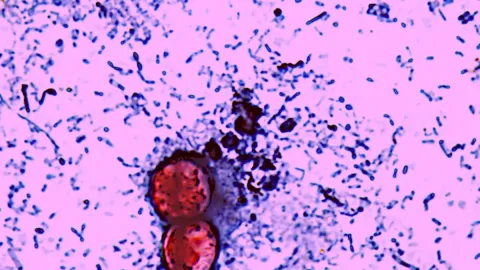 The Explosive Diarrhea Outbreak Has Turned Deadly