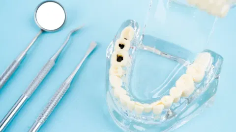 Liquid Fluoride Can Stop Cavities Without Drilling, Major Trial Finds