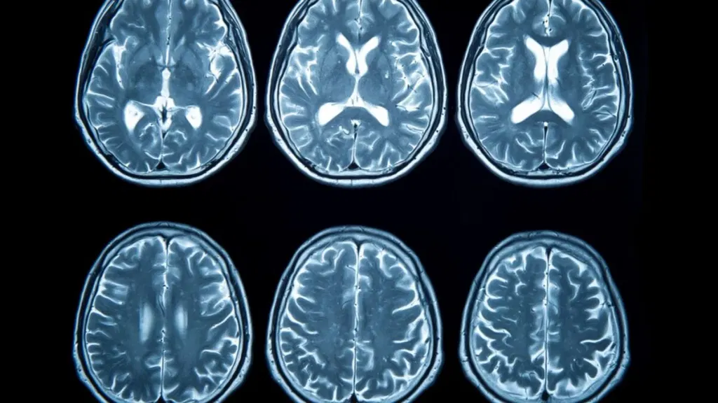 Stroke Rates in Younger Americans Have Nearly Doubled Since the 90s—and Scientists Can’t Fully Explain It