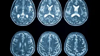 Stroke Rates in Younger Americans Have Nearly Doubled Since the 90s—and Scientists Can’t Fully Explain It