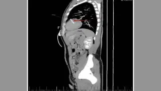 Doctors Scanned This Man’s Chest and Found a Sewing Needle in His Heart