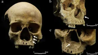 This Skeleton May Prove That Imperial China Really Did Cut Off Noses as Punishment