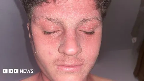 Skin cream withdrawal pain 'like being electrocuted' left footballer stuck in bed