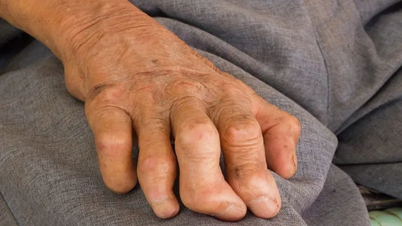 Monthly Triple-Drug Combo Lowers Immune Reactions in Leprosy