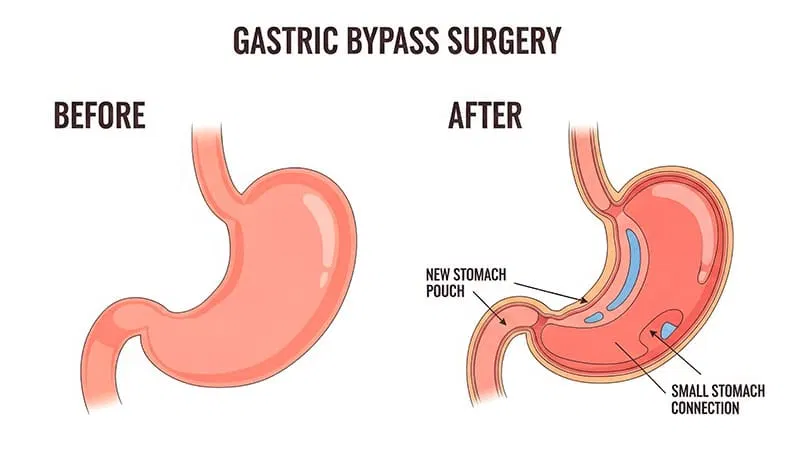 Surgery or Meds for Weight Regain After Sleeve Gastrectomy?