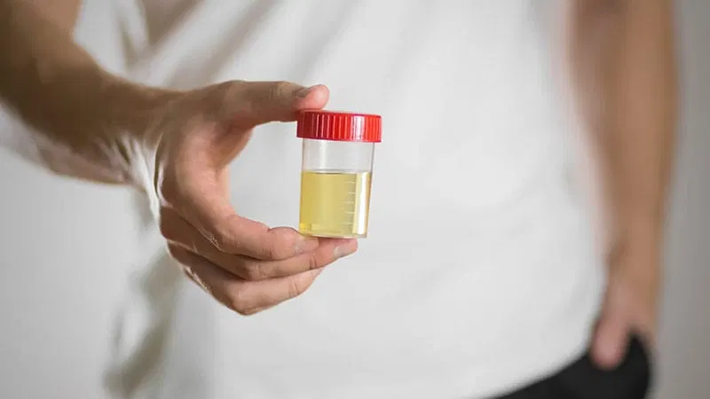 Urine Test Could Detect Lung Cancer Years Early