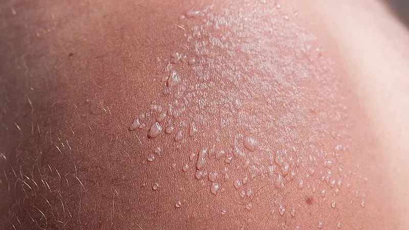 US Survey Finds Sunburn Reports Common, Even With Sunscreen
