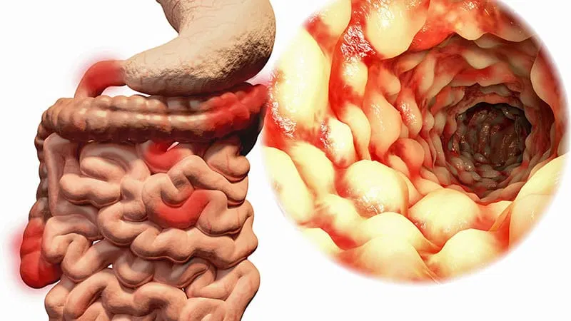 Genital Lesions Most Common Sign of CCD