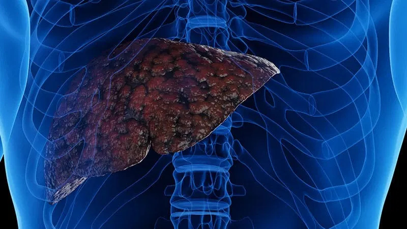 Remote Monitoring in Cirrhosis Could Reduce Admissions