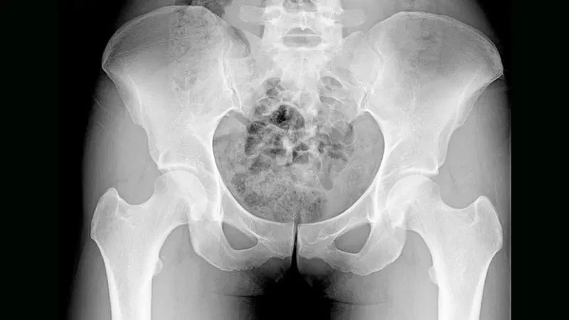 Femoral BMD May Reflect Broader Health in Older Women