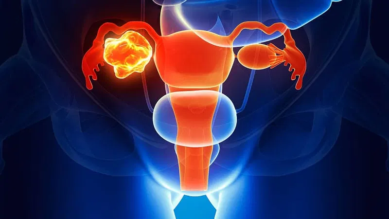 Chiauranib Slows Platinum-Resistant Ovarian Cancer