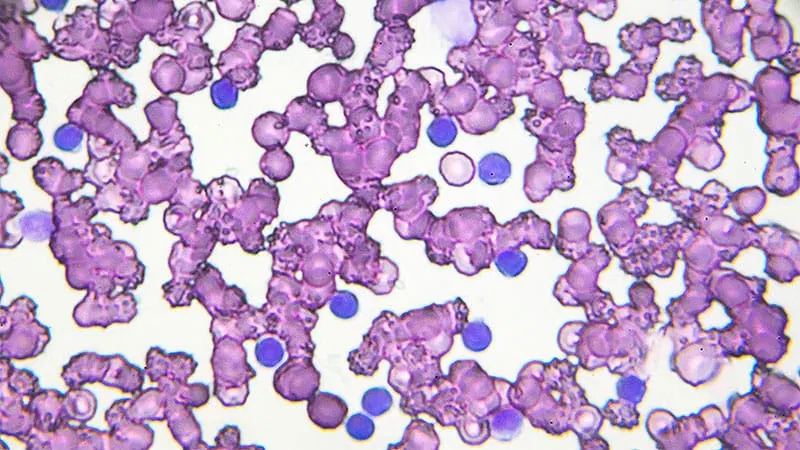 Is Venetoclax Retreatment Effective in Relapsed CLL?