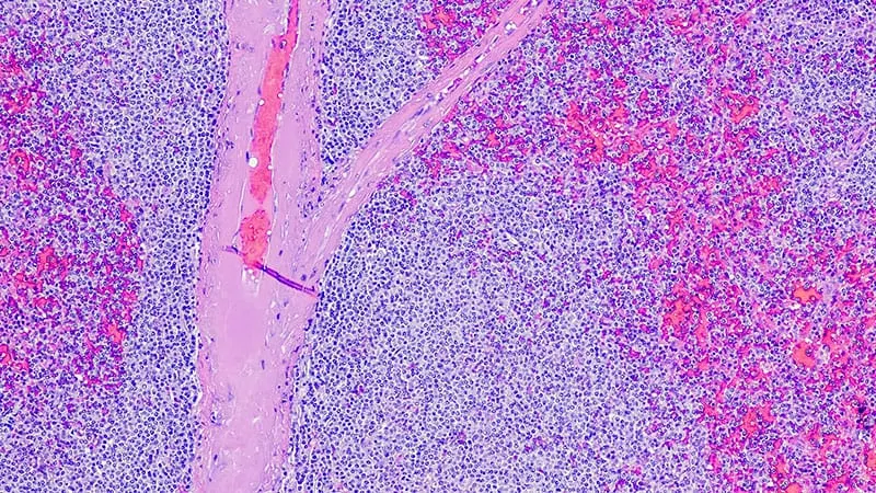Blood Test Flags Mantle Cell Lymphoma Relapse Before PET-CT