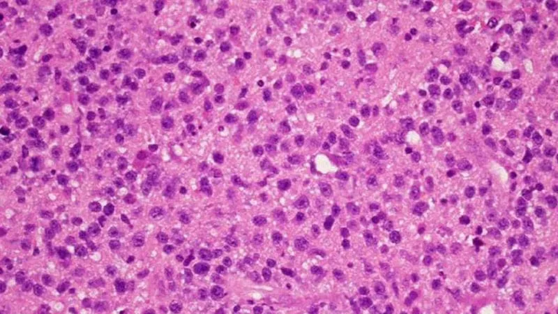 CSF Biomarker Panel May Improve Diagnosis of CNS Lymphoma