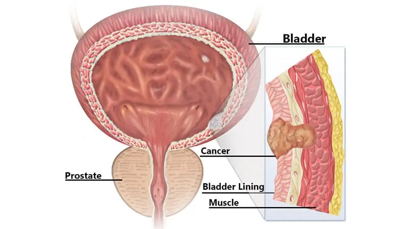 Adjuvant Radiation Boosts High-Risk Bladder Cancer Control