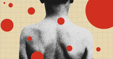 The Backward Logic of Chickenpox Parties