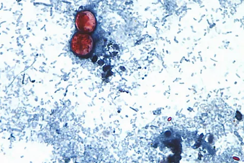 US health officials investigate new outbreak of diarrhea-causing parasite