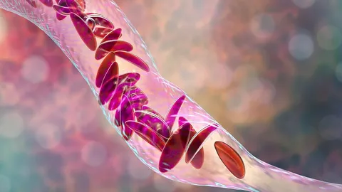 Experts stress early diagnosis and identifying underlying cause of anaemia