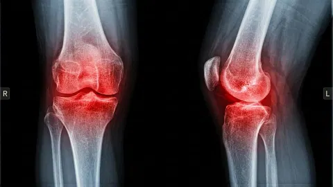 Scientists discover simple way to relieve arthritis pain without pills or surgery