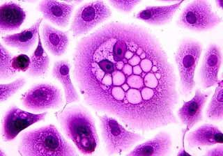 Researchers use genetically engineered immune cells to put a child's metastatic cancer into remission